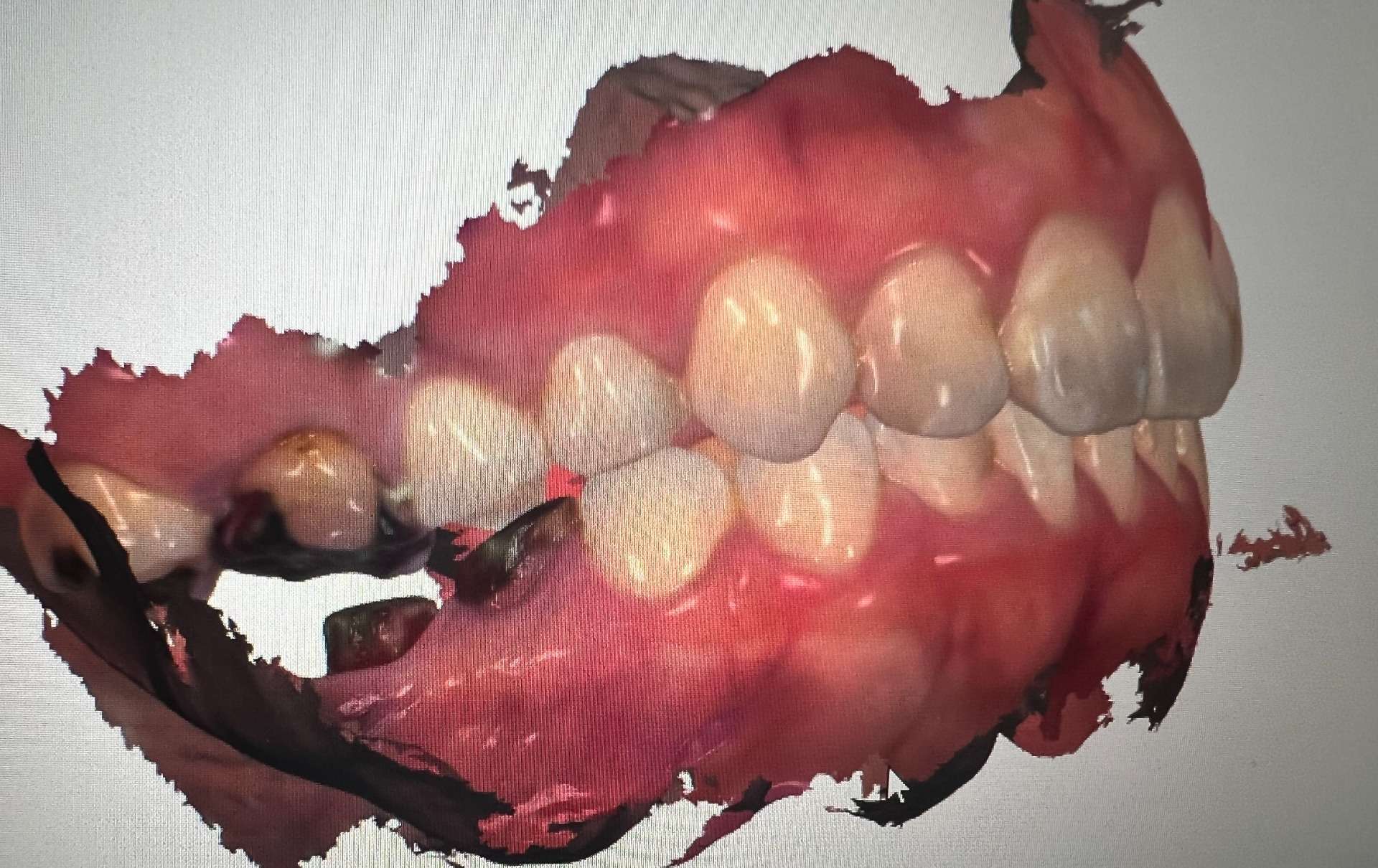 歯科用CTと口腔内3Dスキャナーによる的確な診断